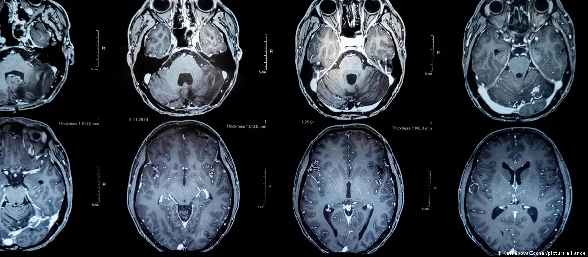 Vacina experimental apresenta resultados promissores contra tumores cerebrais agressivos