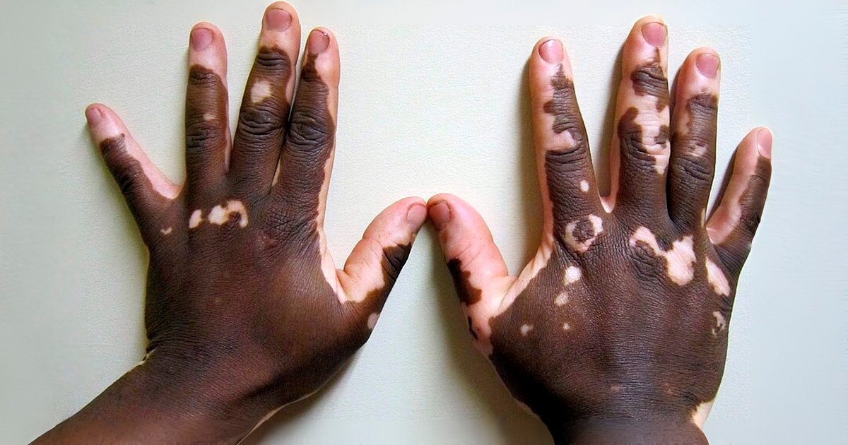 Nanotecnologia e terapia genética apontam novos caminhos para tratar o vitiligo, mostra estudo da USP