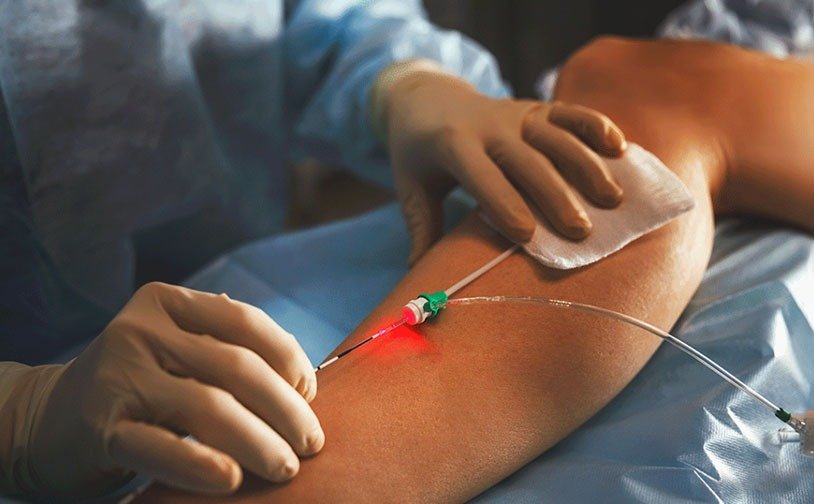 Laser reduz tempo de recuperação e permite tratar varizes sem internação