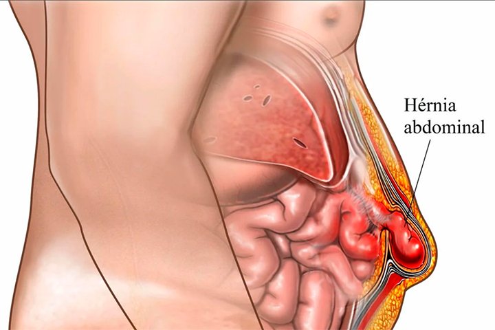 Especialista comenta aumento de casos de hérnia abdominal em atletas de alto rendimento